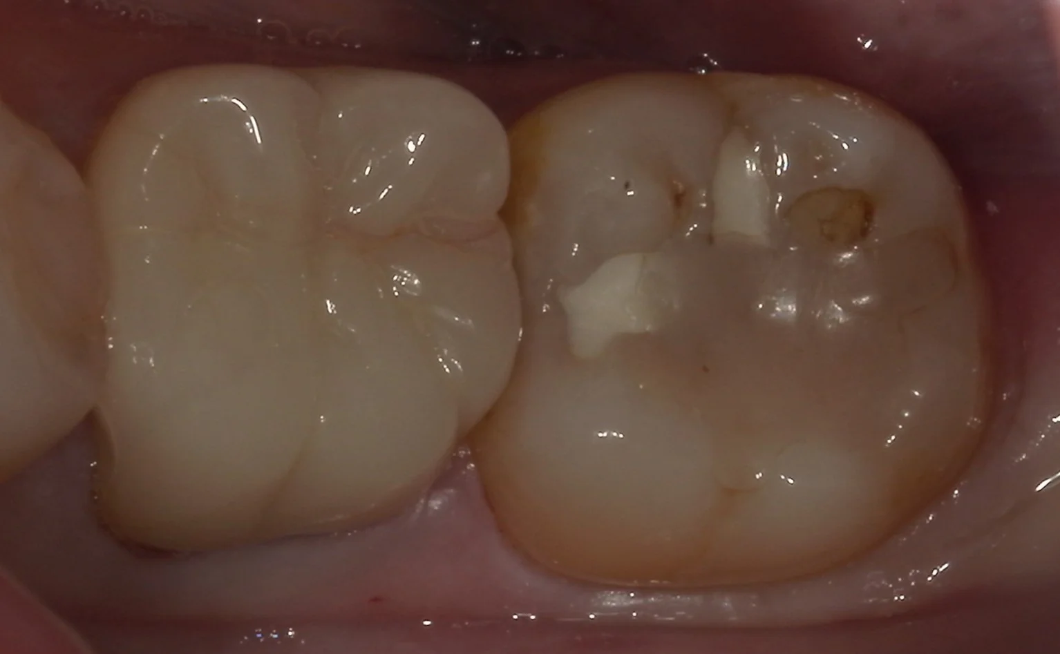 遠方より虫歯の治療で通院された方を一日で治療しました。｜坂寄歯科医院（取手市藤代）