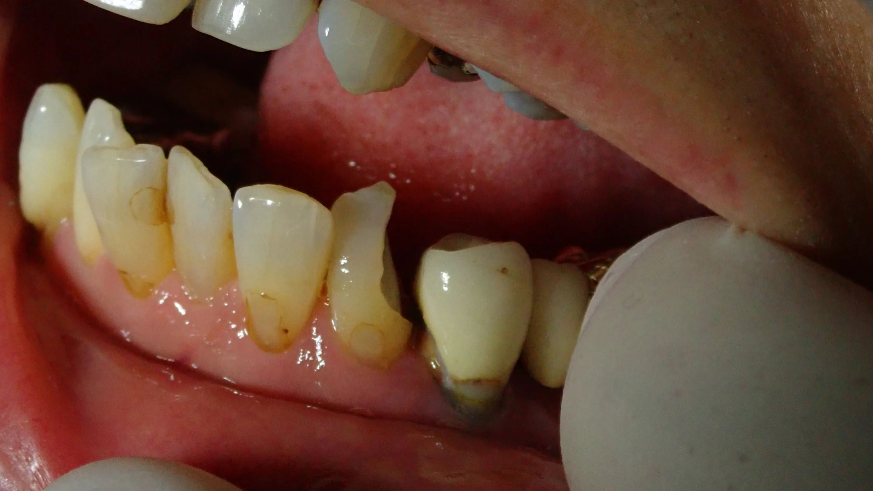 下顎前歯ダイレクトボンディング|坂寄歯科医院(取手市藤代)