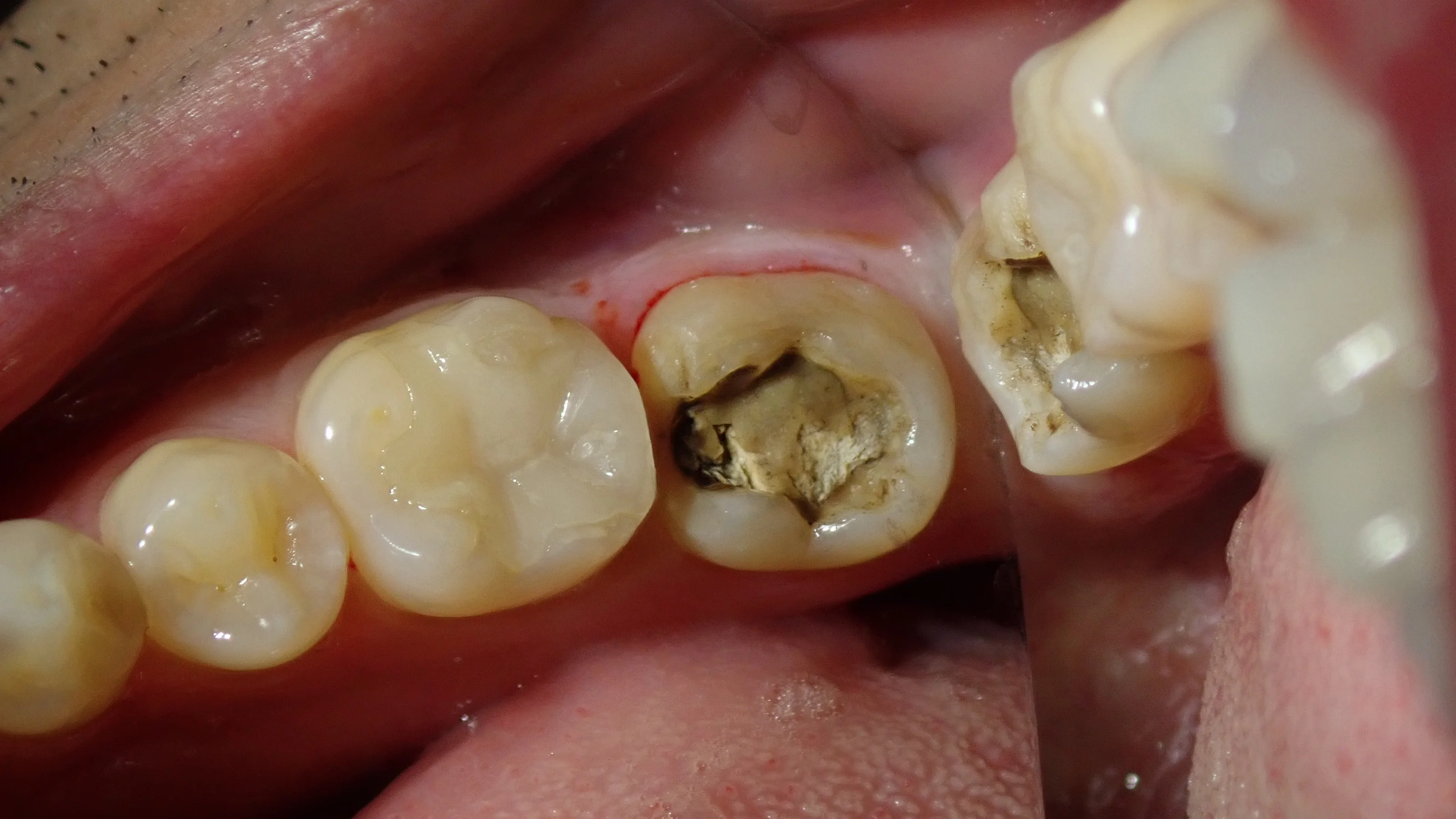 左下奥の白い詰め物｜坂寄歯科医院（取手市藤代）
