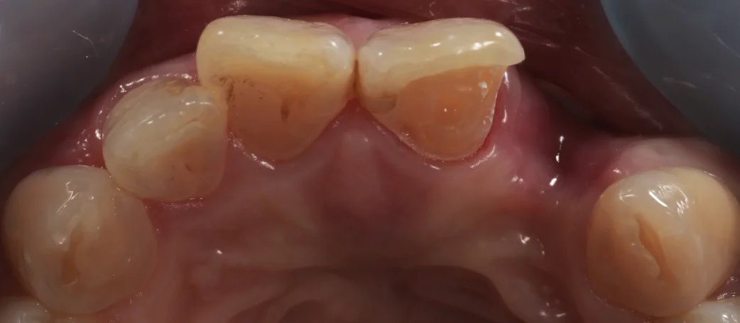 審美治療+歯質保存:延長セラミックブリッジ|坂寄歯科医院(取手市藤代) - 画像3