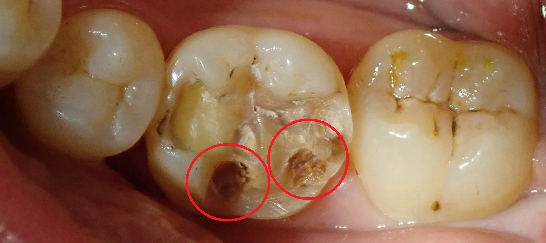 奥歯の白い詰め物｜坂寄歯科医院（取手市藤代） - 画像2