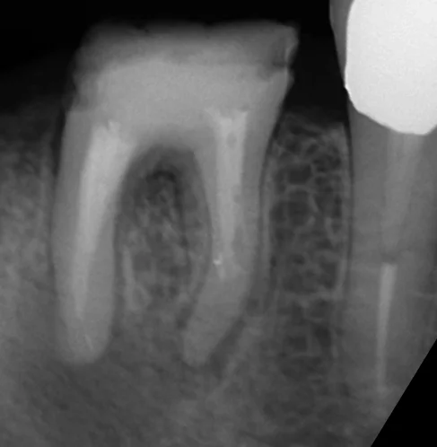 パーフォレーションリペア｜坂寄歯科医院（取手市藤代） - 画像3