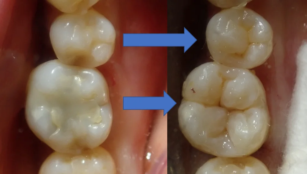 ダイレクトボンディング⑦|坂寄歯科医院(取手市藤代) - 画像6