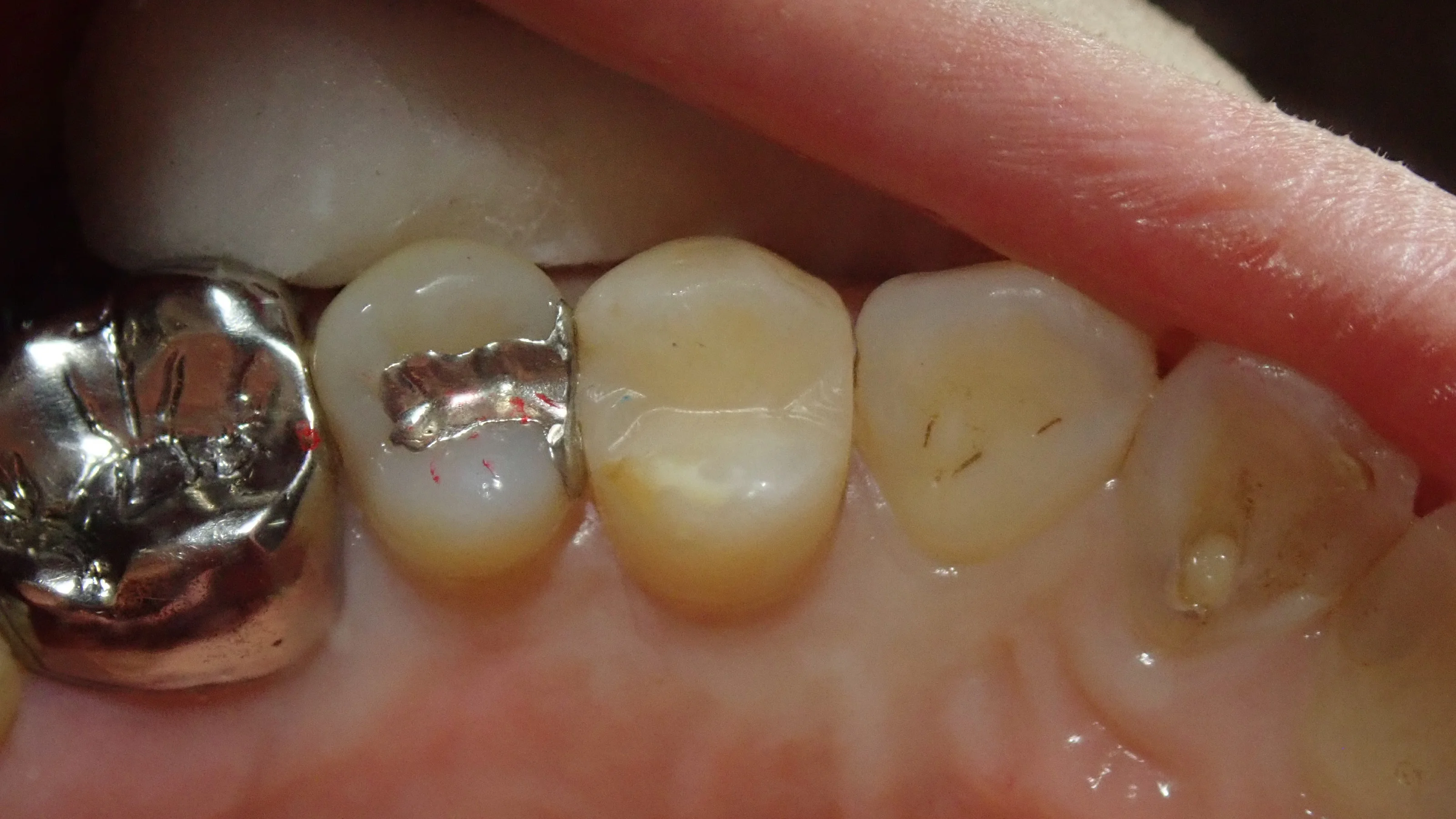 小さい奥歯(小臼歯)の白い詰め物|坂寄歯科医院(取手市藤代) - 画像6