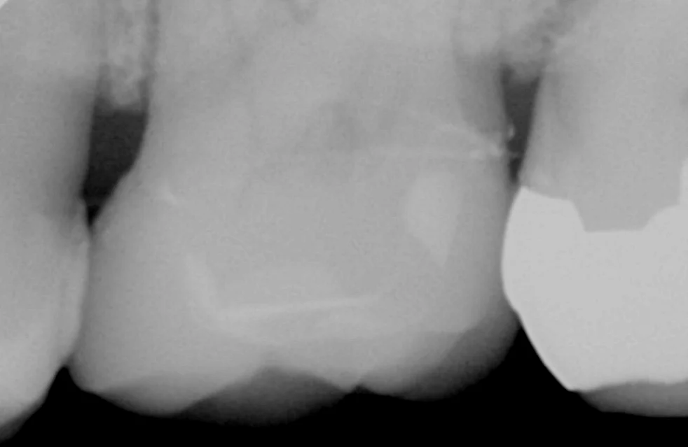 虫歯の治療後セラミックの被せ物に。｜坂寄歯科医院（取手市藤代） - 画像5