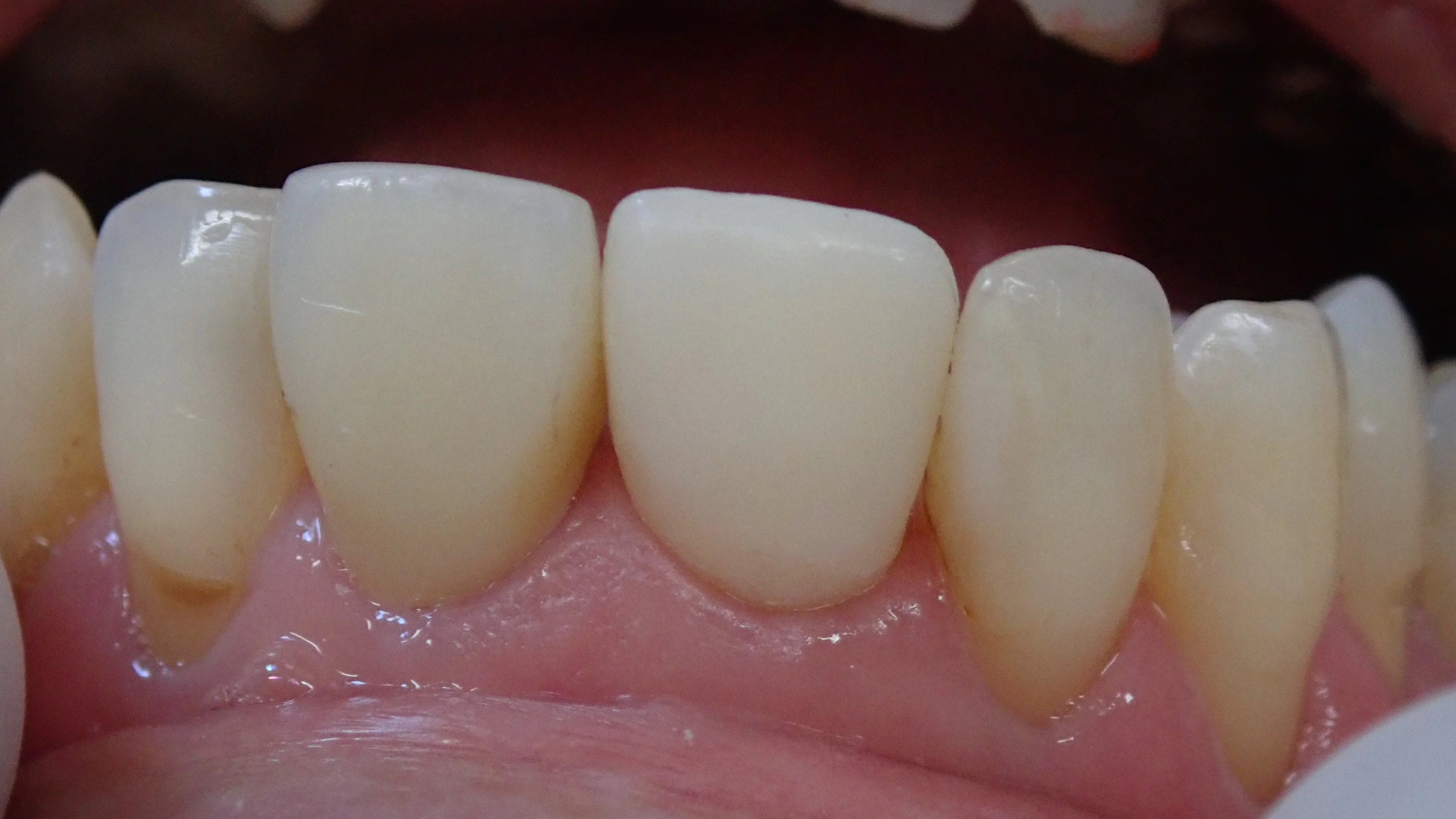 仮歯へのこだわり。その2|坂寄歯科医院(取手市藤代)