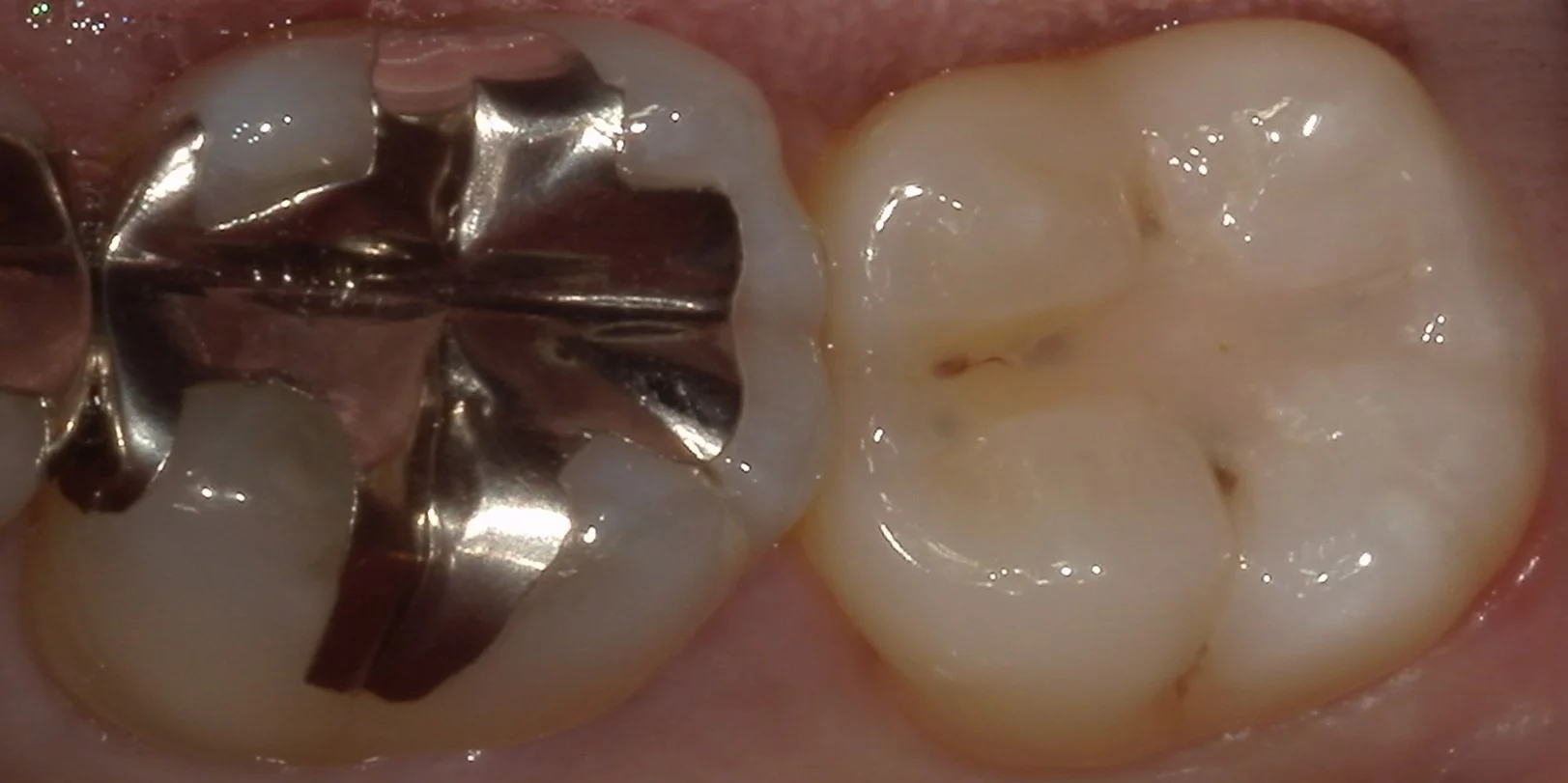 小さな虫歯ほど自費がおすすめ。｜坂寄歯科医院（取手市藤代）