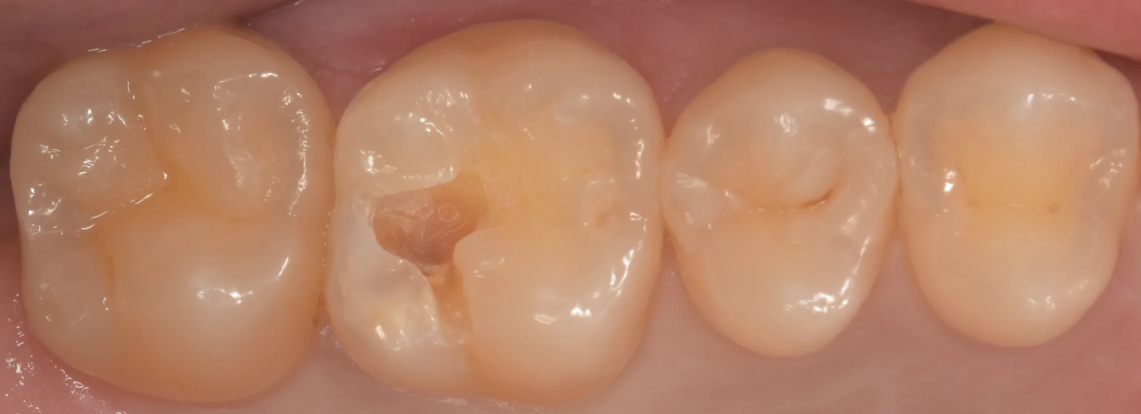 遠方より歯の治療を希望して｜坂寄歯科医院（取手市藤代） - 画像2