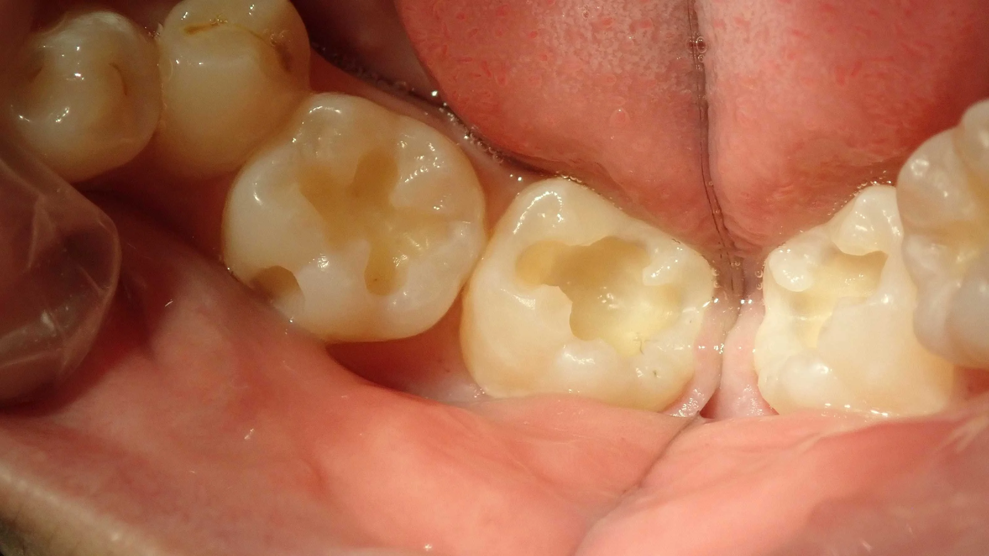 コンポジットレジン修復｜坂寄歯科医院（取手市藤代） - 画像2