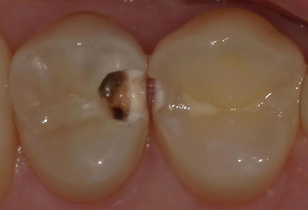 歯科医師の方の虫歯治療。|坂寄歯科医院(取手市藤代) - 画像2