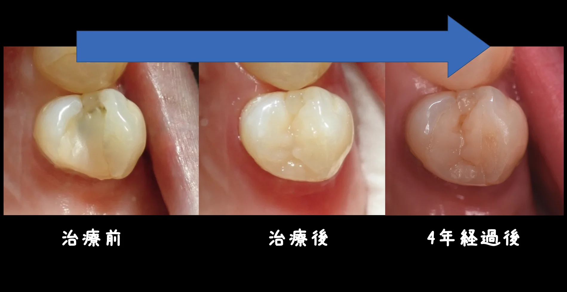 ダイレクトボンディング術後4年での補修修復|坂寄歯科医院(取手市藤代) - 画像6