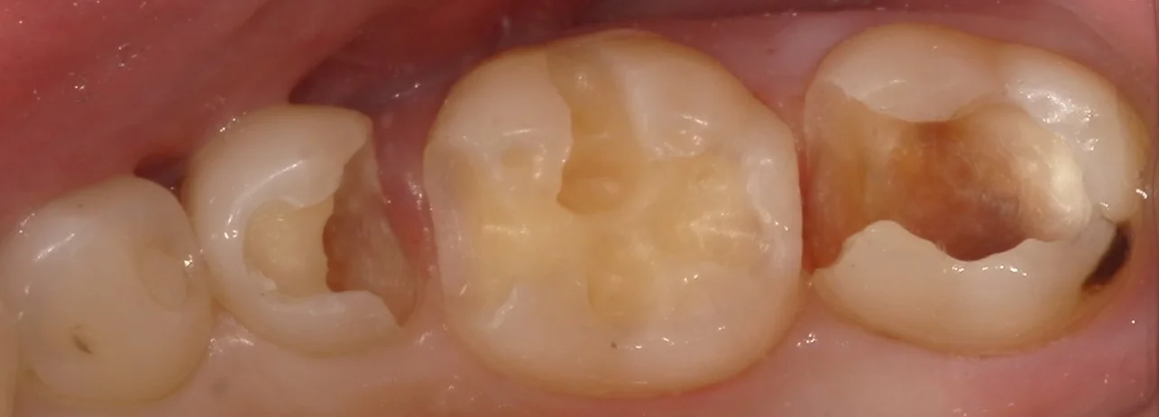 1回で纏めて一気に白い歯へ。|坂寄歯科医院(取手市藤代) - 画像3