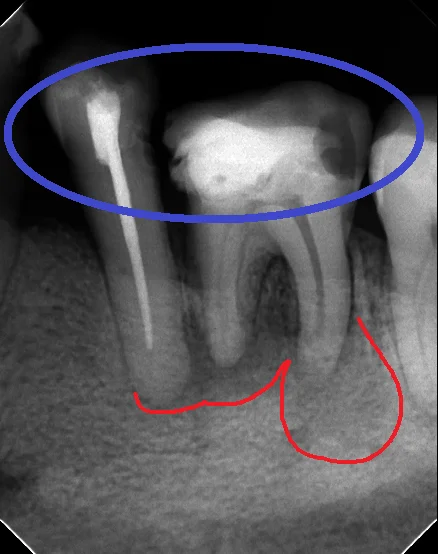 レジンでは無理ですって！再び･･･｡｜坂寄歯科医院（取手市藤代）