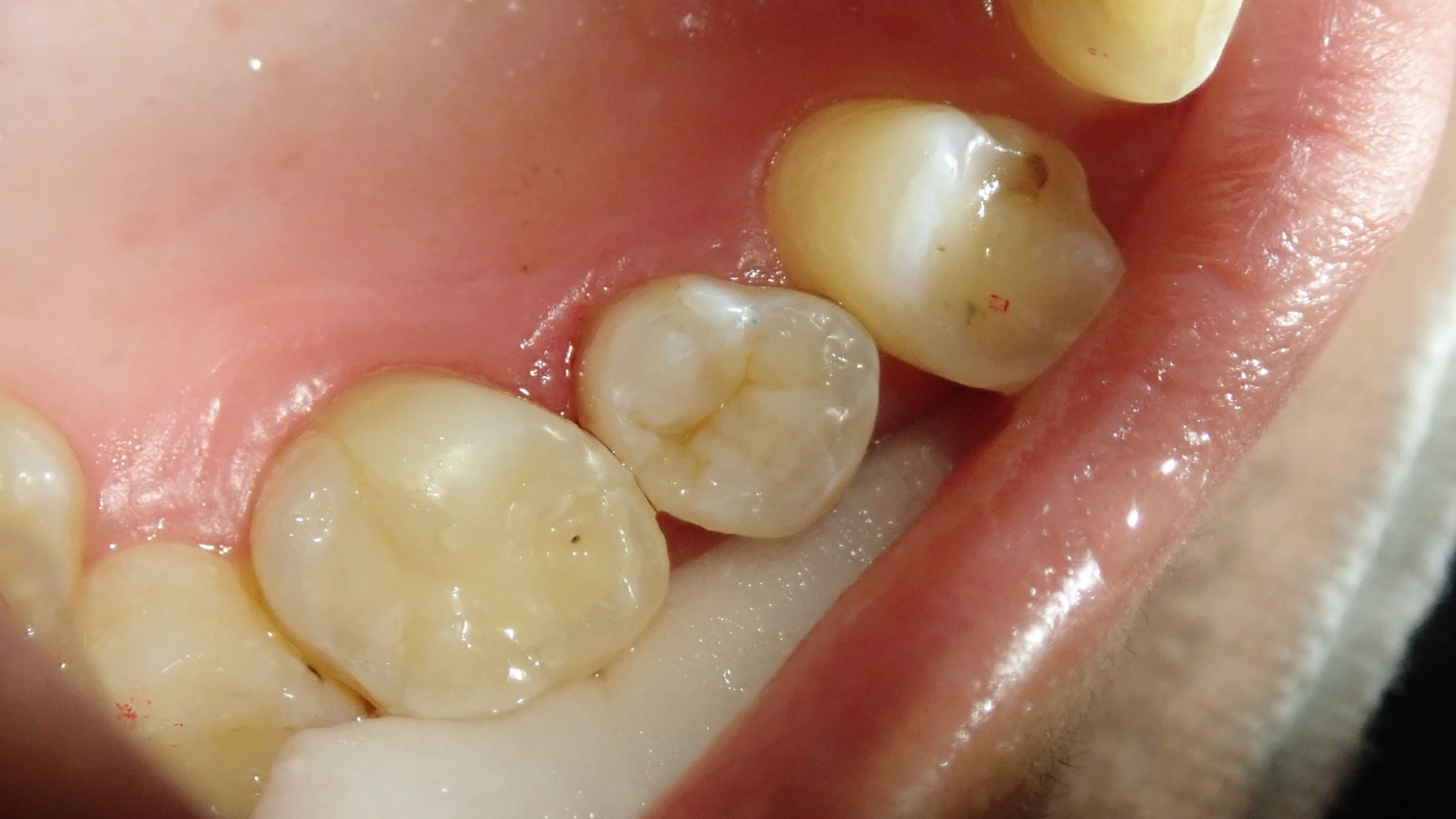 上顎小臼歯ダイレクトボンディング|坂寄歯科医院(取手市藤代) - 画像3