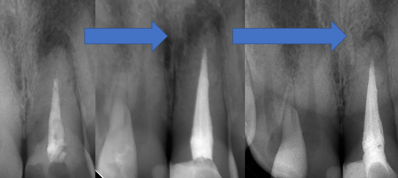 前歯の根管治療|坂寄歯科医院(取手市藤代) - 画像4