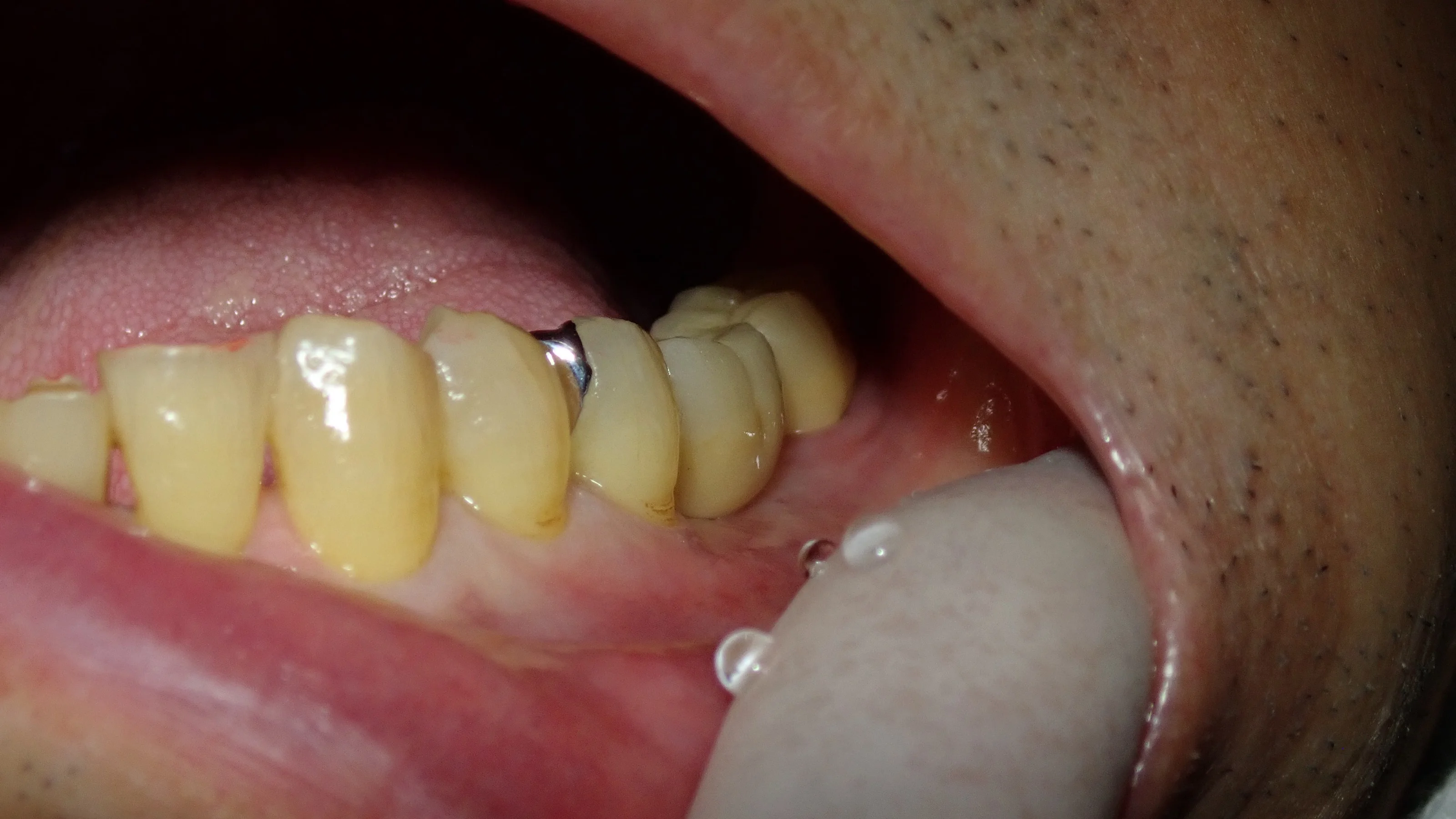 歯を可及的に温存したブリッジ|坂寄歯科医院(取手市藤代) - 画像7