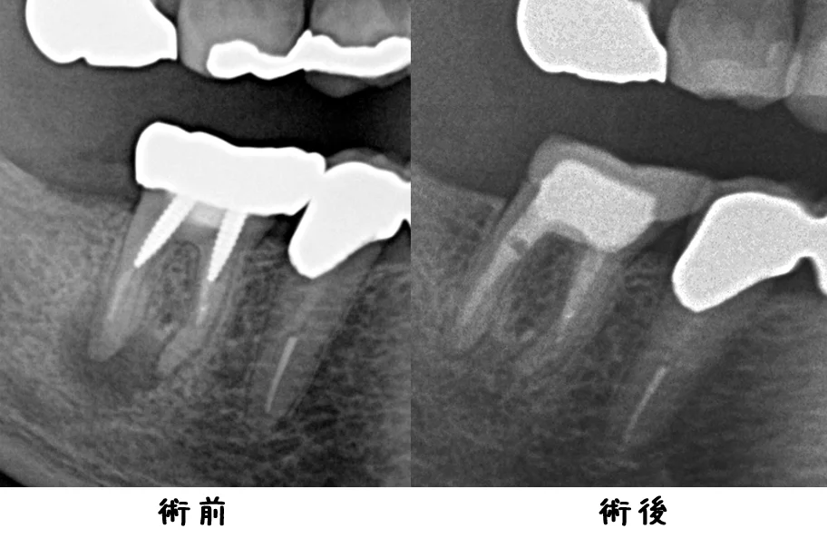 パーフォレーションリペア｜坂寄歯科医院（取手市藤代） - 画像4