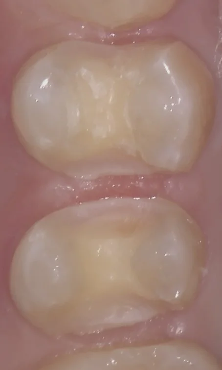 右上小さい奥歯の白い詰め物｜坂寄歯科医院（取手市藤代） - 画像2