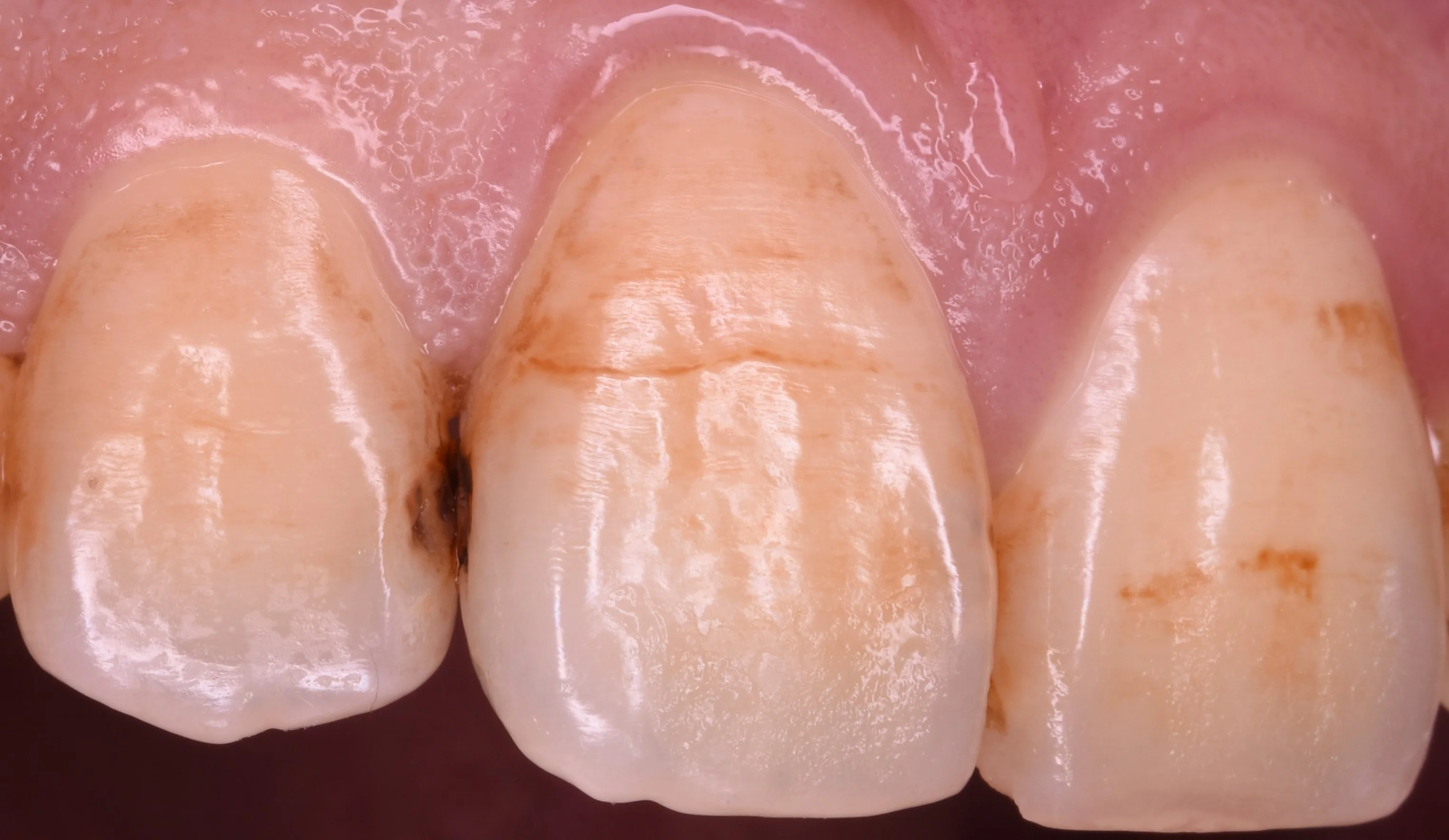 前歯の虫歯の治療で可能な限り歯を温存したケース。｜坂寄歯科医院（取手市藤代）