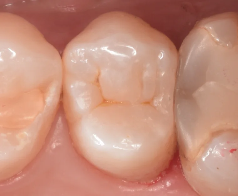 開業歯科医師の方を治療。｜坂寄歯科医院（取手市藤代） - 画像4