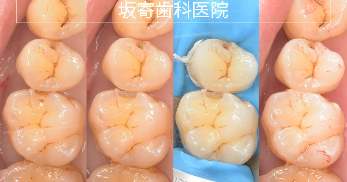 ブログ・お役立ち情報｜坂寄歯科医院（取手市藤代）