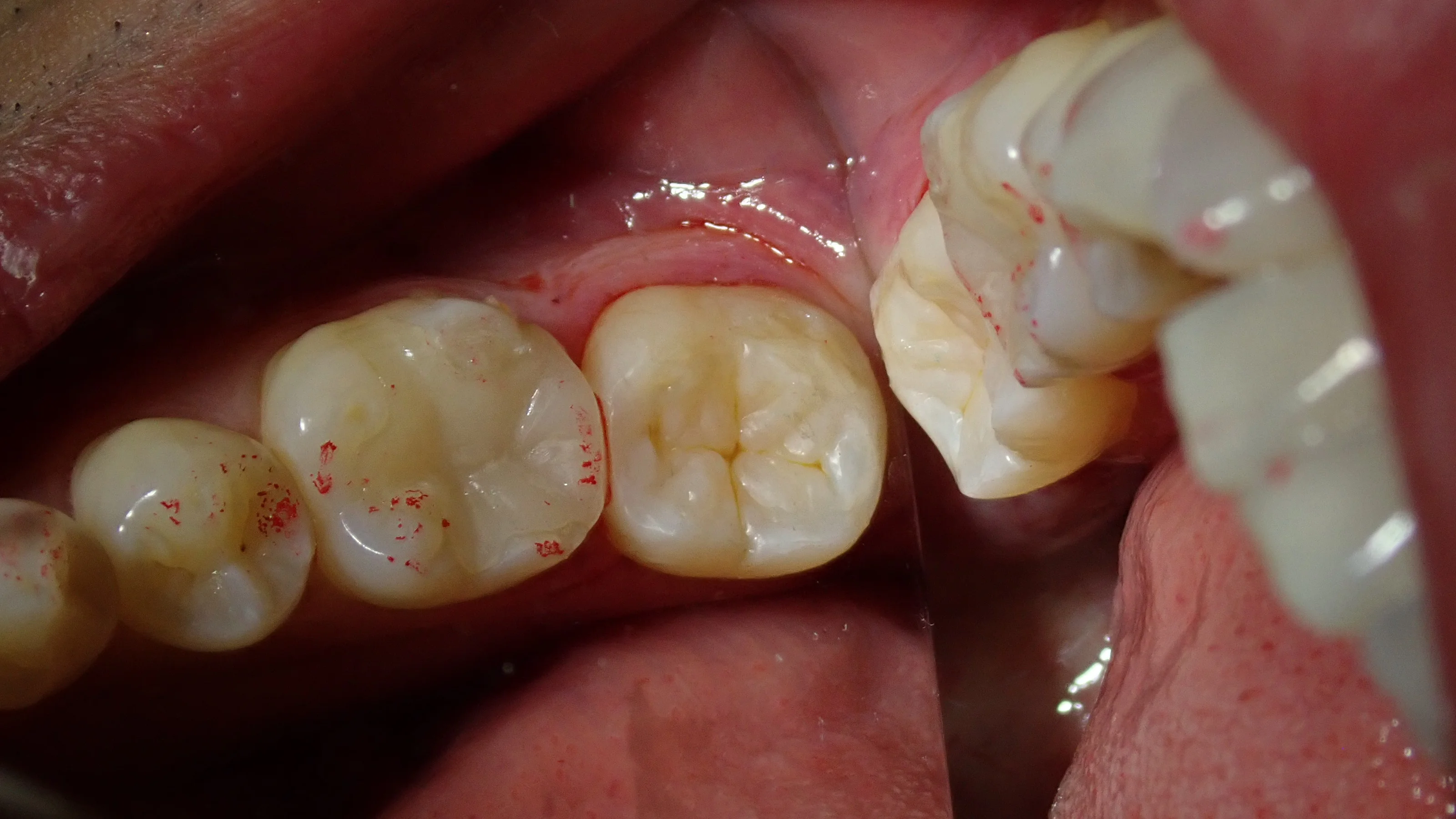 左下奥の白い詰め物｜坂寄歯科医院（取手市藤代） - 画像3