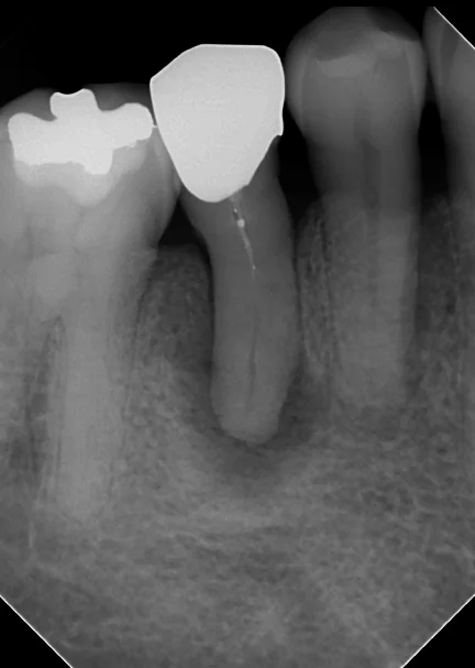閉鎖根管の治療には根気が必要|坂寄歯科医院(取手市藤代)