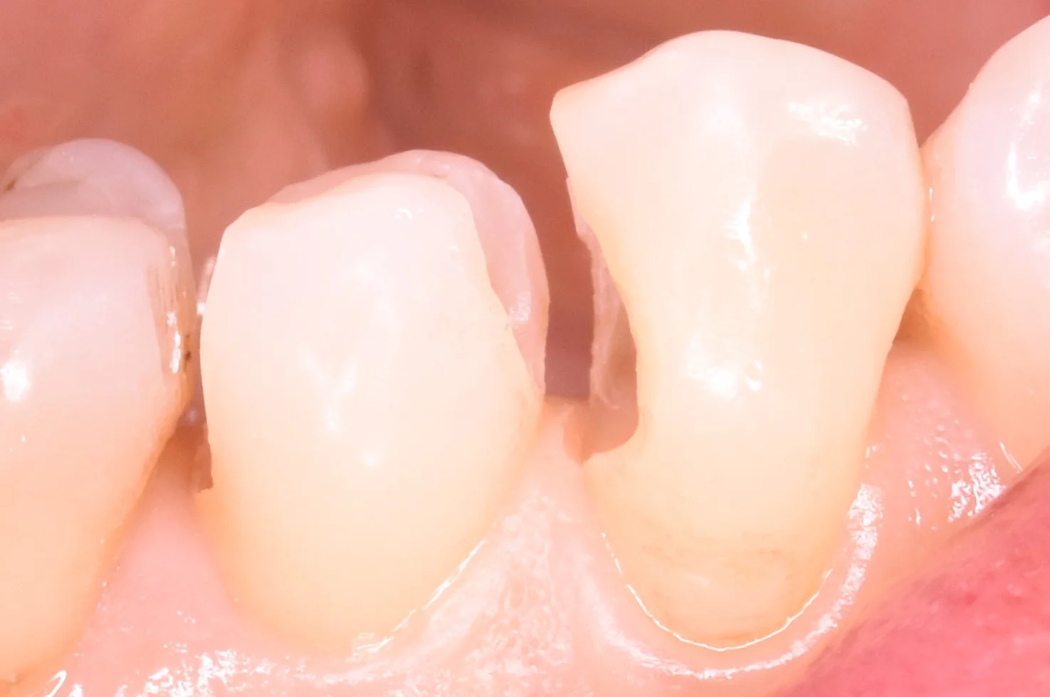 奥歯の歯並びが悪くなってしまっている所の治療｜坂寄歯科医院（取手市藤代） - 画像4