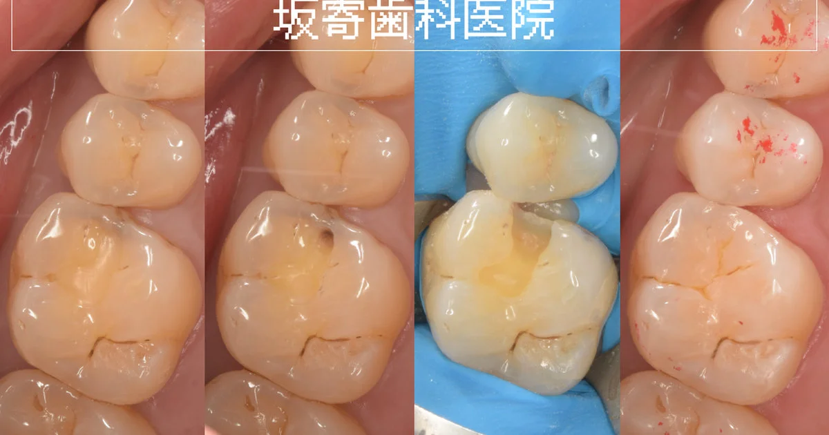 ブログ・お役立ち情報｜坂寄歯科医院（取手市藤代）