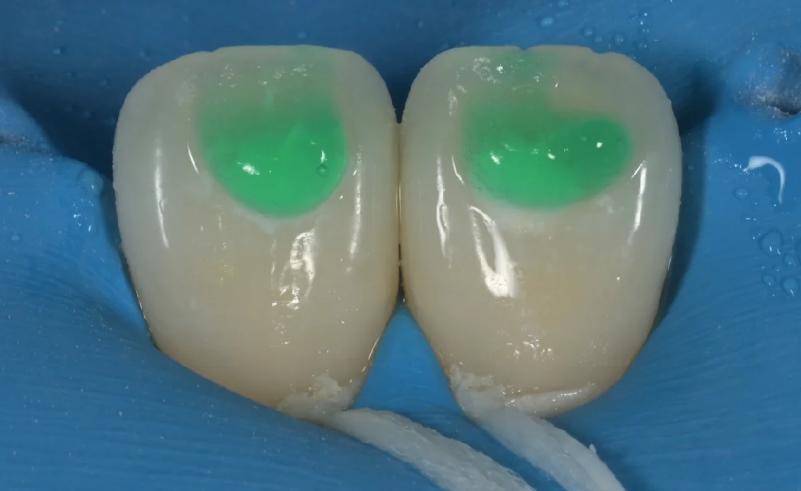 ICON治療。|坂寄歯科医院(取手市藤代) - 画像4