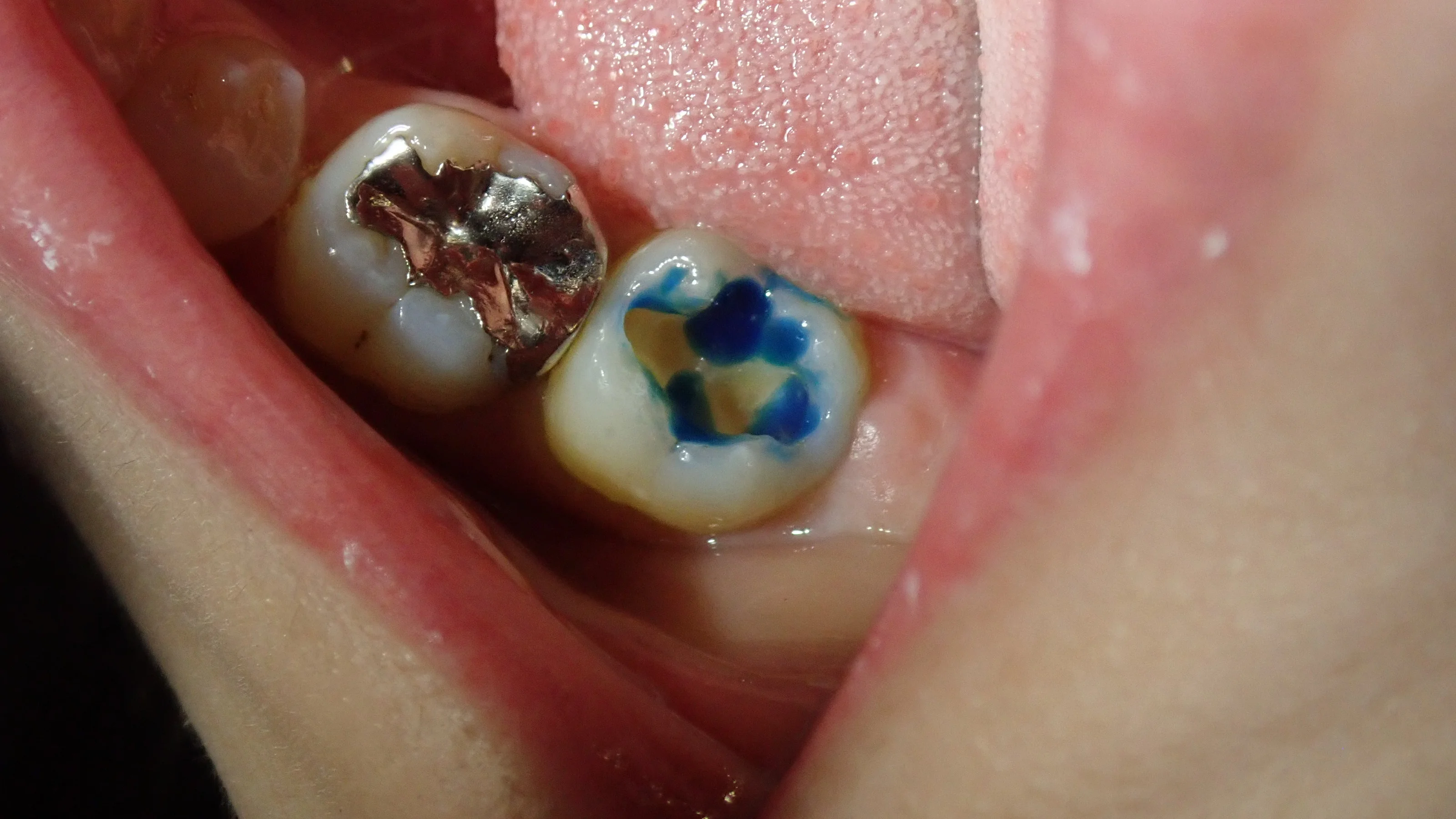 奥2本のダイレクトボンディング|坂寄歯科医院(取手市藤代) - 画像2