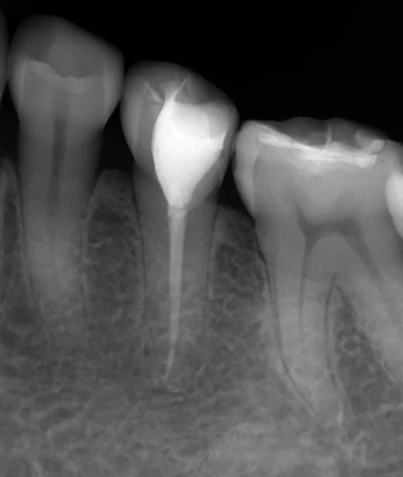 詰め物が欠けたまま放置した結果･･･｜坂寄歯科医院（取手市藤代） - 画像3