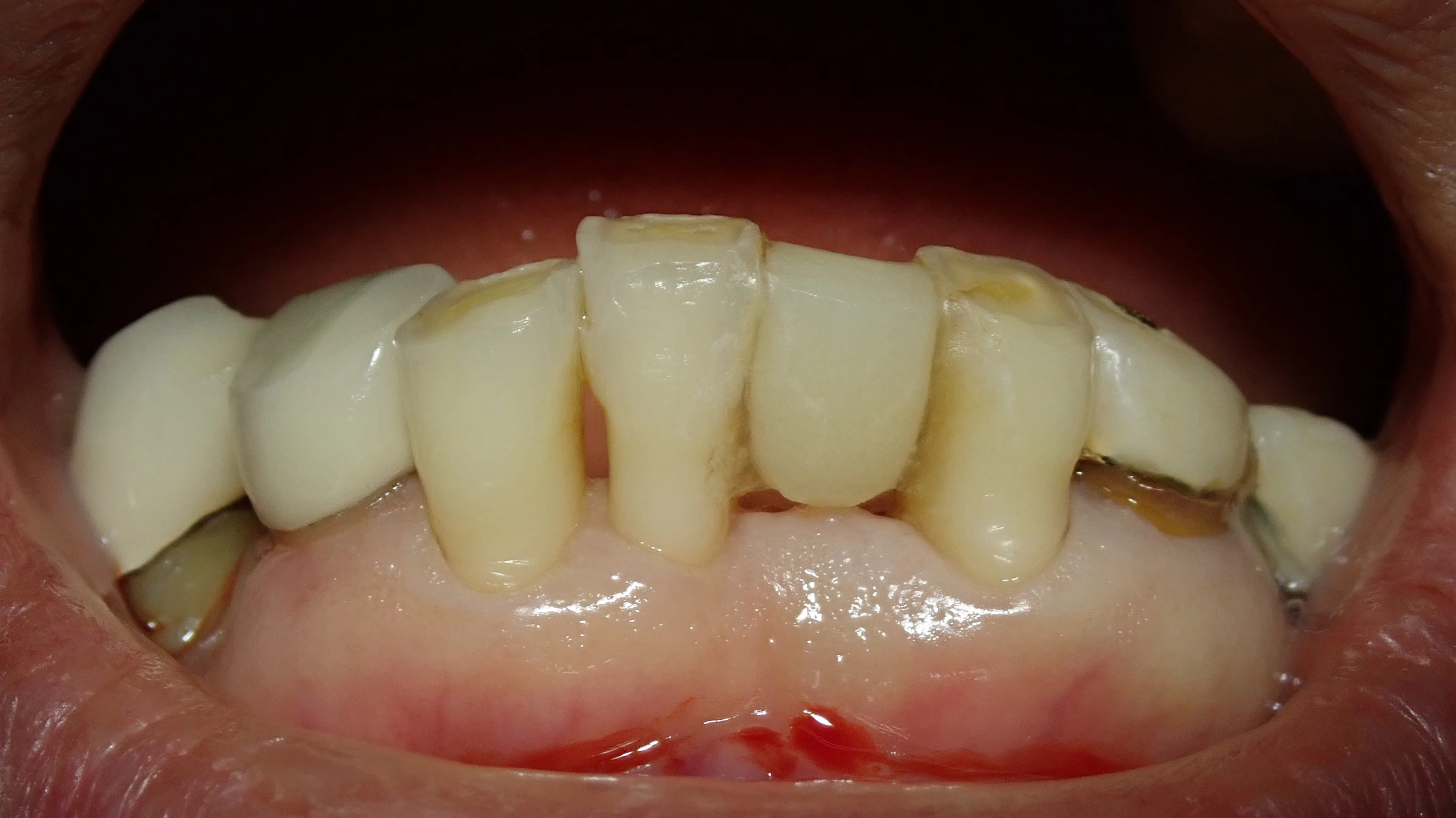 接着性ブリッジ|坂寄歯科医院(取手市藤代)