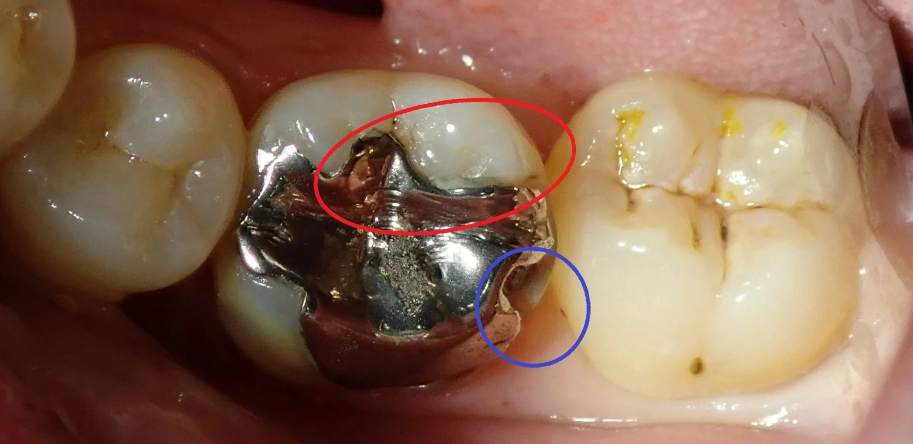奥歯の白い詰め物｜坂寄歯科医院（取手市藤代）