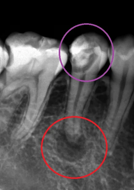 神経の治療③｜坂寄歯科医院（取手市藤代）