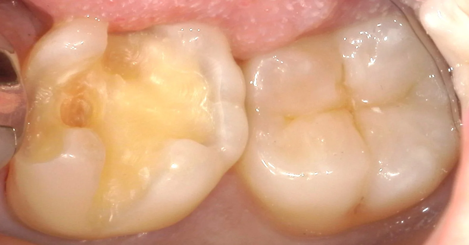 奥歯の自費の白い詰め物。術後数週間後もあります。|坂寄歯科医院(取手市藤代) - 画像3