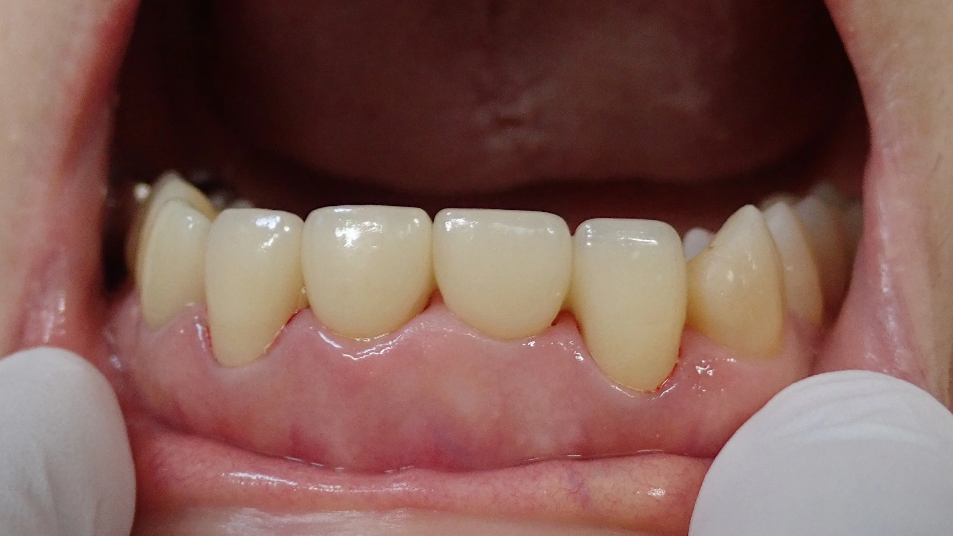 上の前歯の自費診療(セラミック)|坂寄歯科医院(取手市藤代)