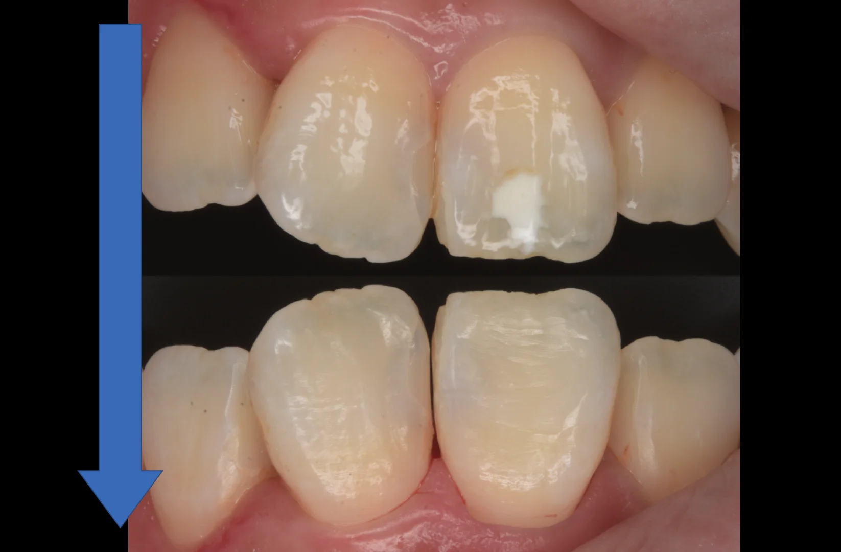 ICON治療にて改善しきらなかったケース。｜坂寄歯科医院（取手市藤代） - 画像4