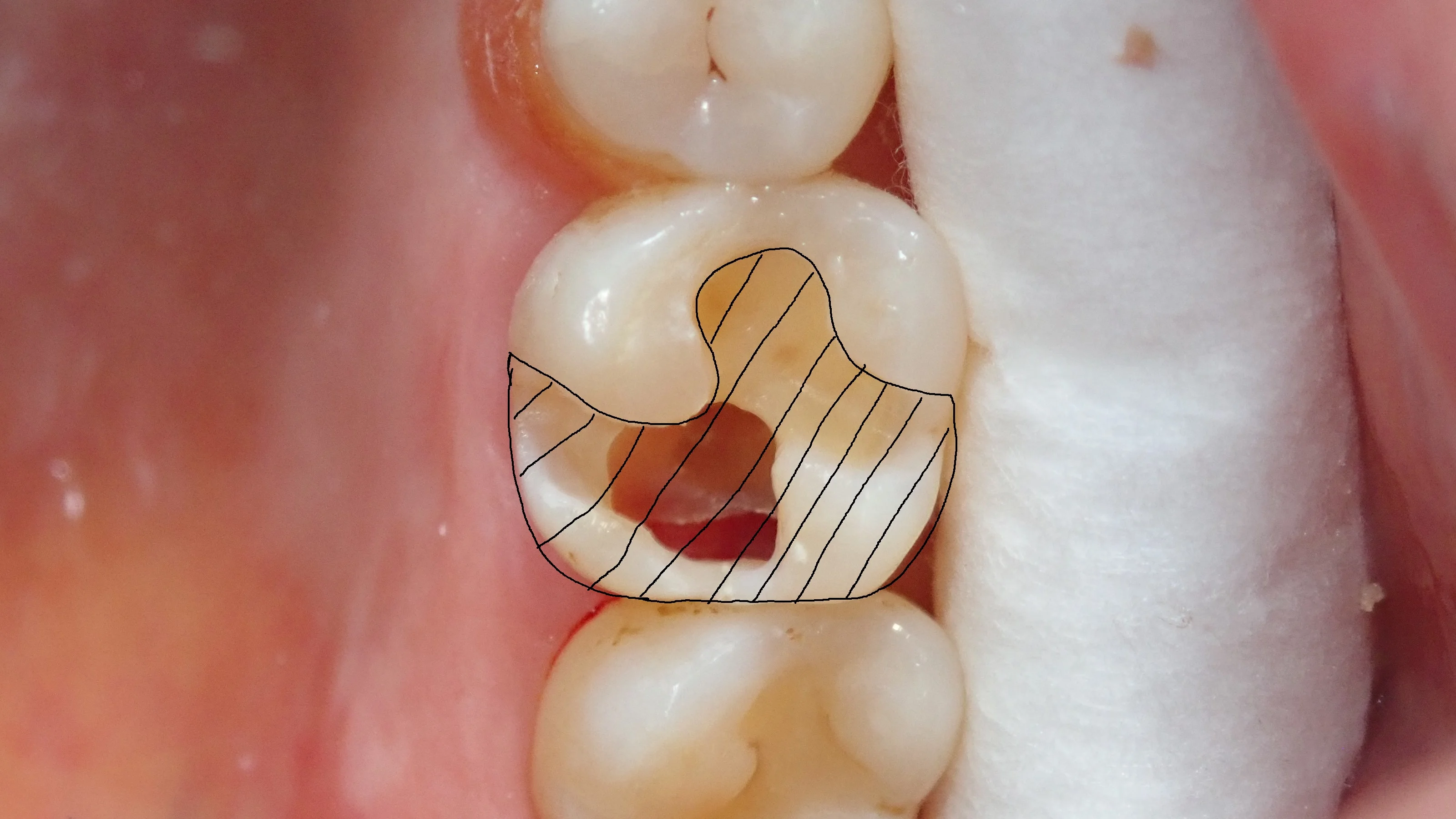 ダイレクトボンディング③（臼歯）｜坂寄歯科医院（取手市藤代） - 画像3
