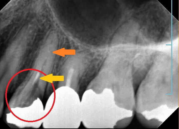 神経の治療⑤|坂寄歯科医院(取手市藤代)