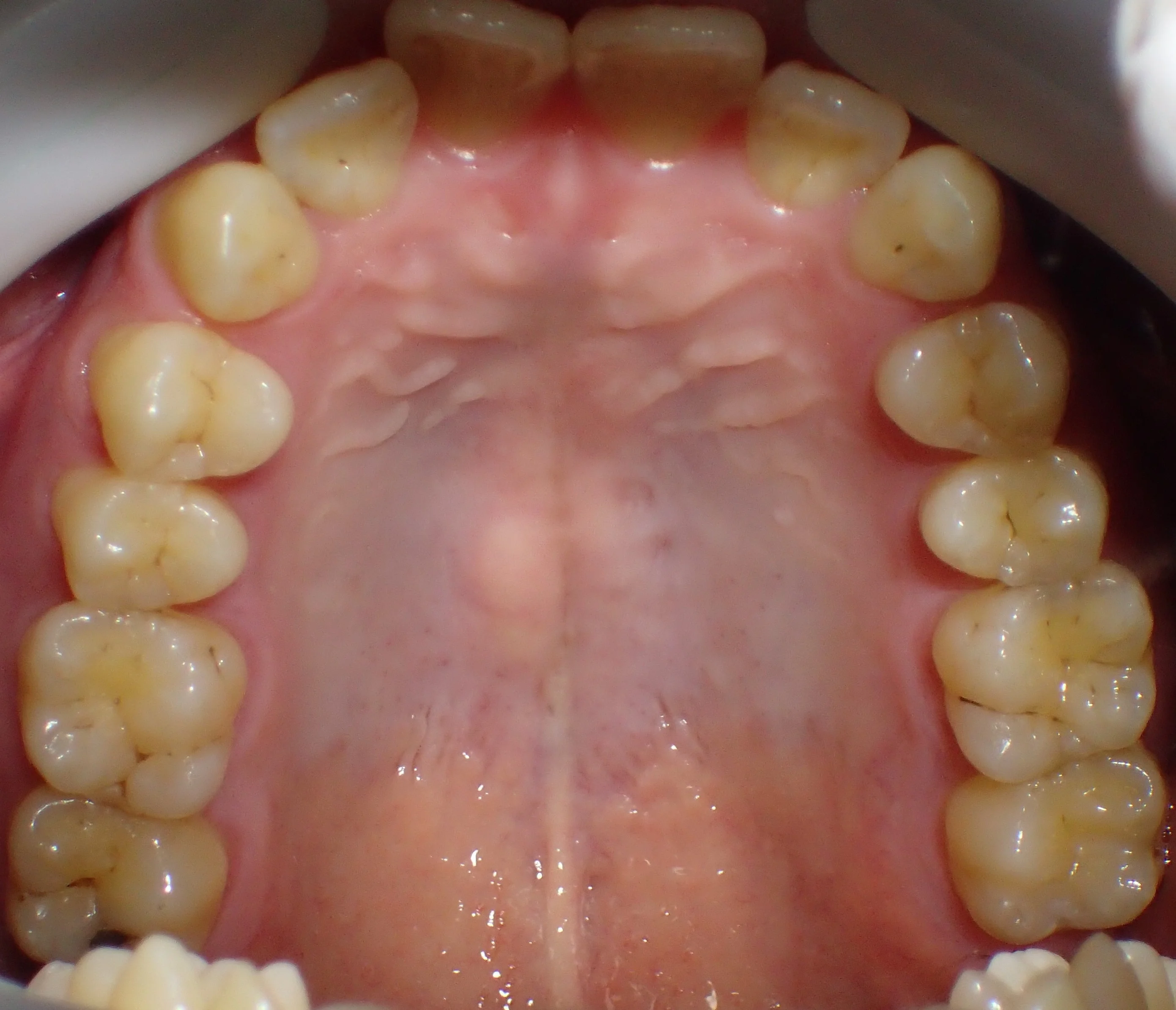ダイレクトボンディングによる治療｜坂寄歯科医院（取手市藤代）