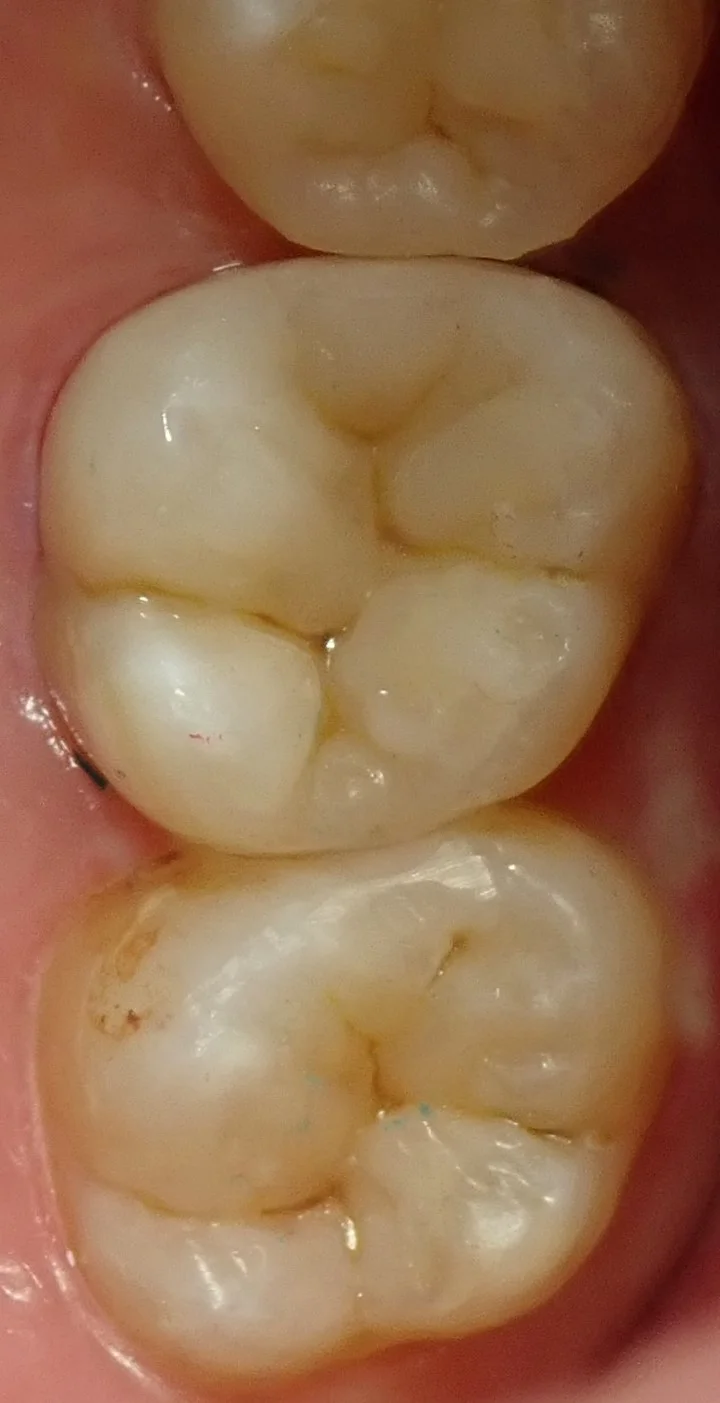 左上奥歯の白い詰め物|坂寄歯科医院(取手市藤代) - 画像4