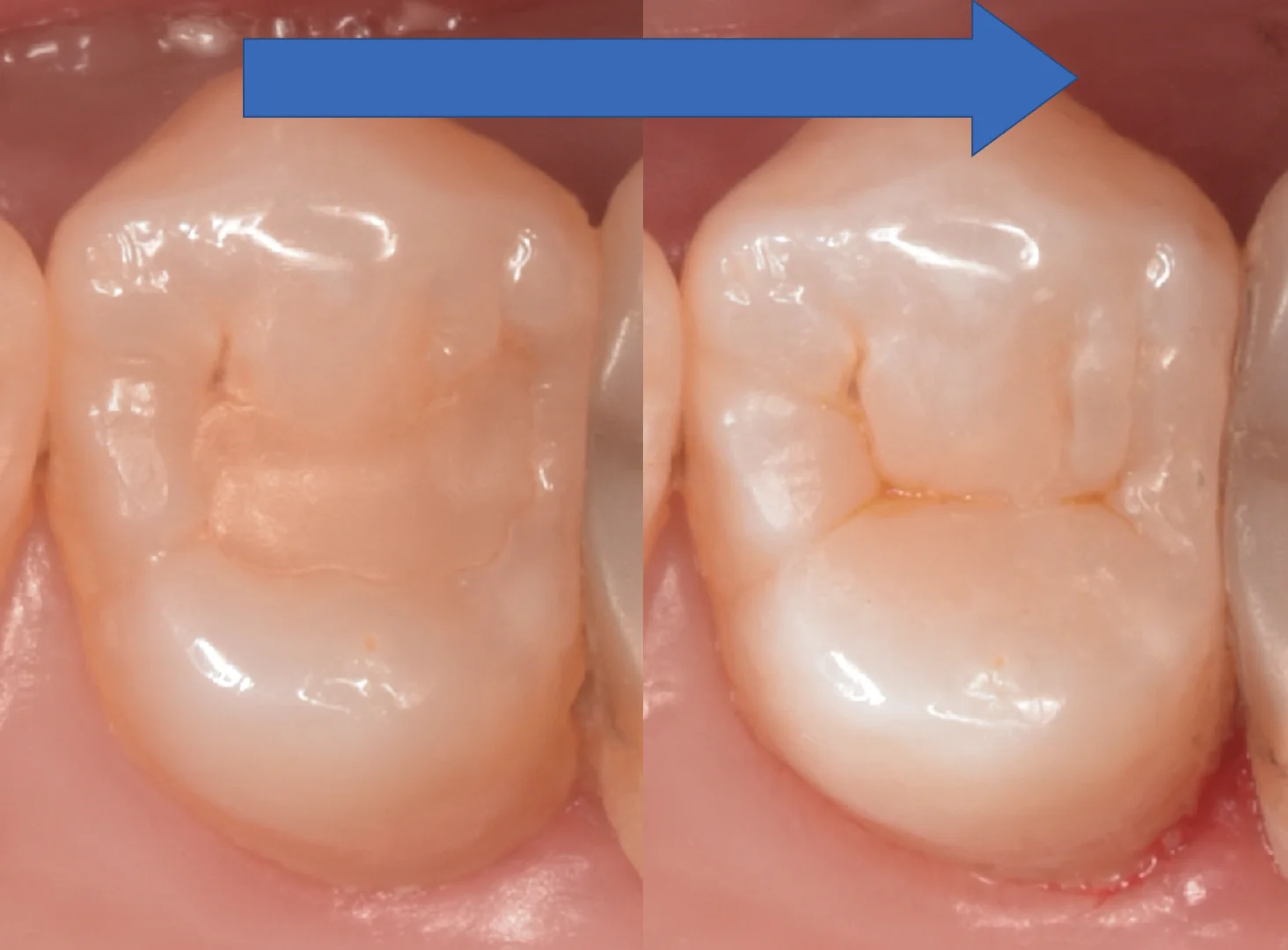 開業歯科医師の方を治療。｜坂寄歯科医院（取手市藤代） - 画像6