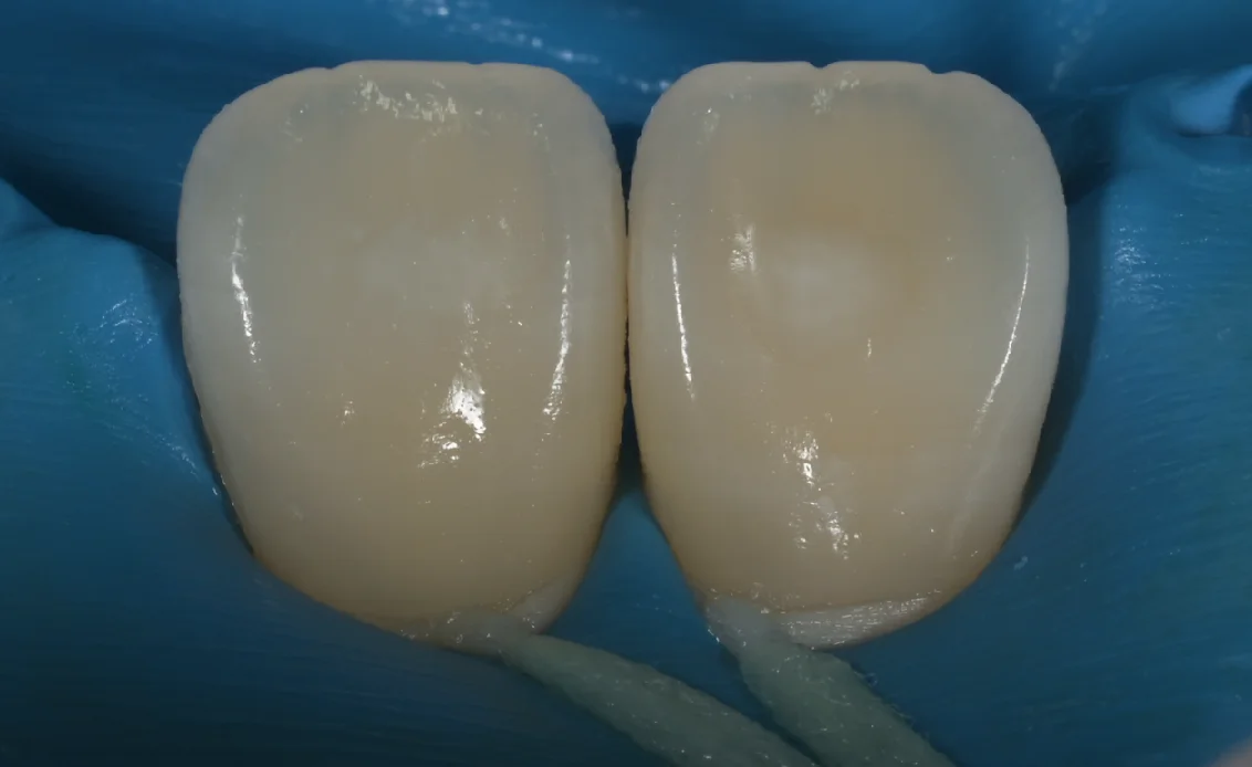 ICON治療。|坂寄歯科医院(取手市藤代) - 画像5