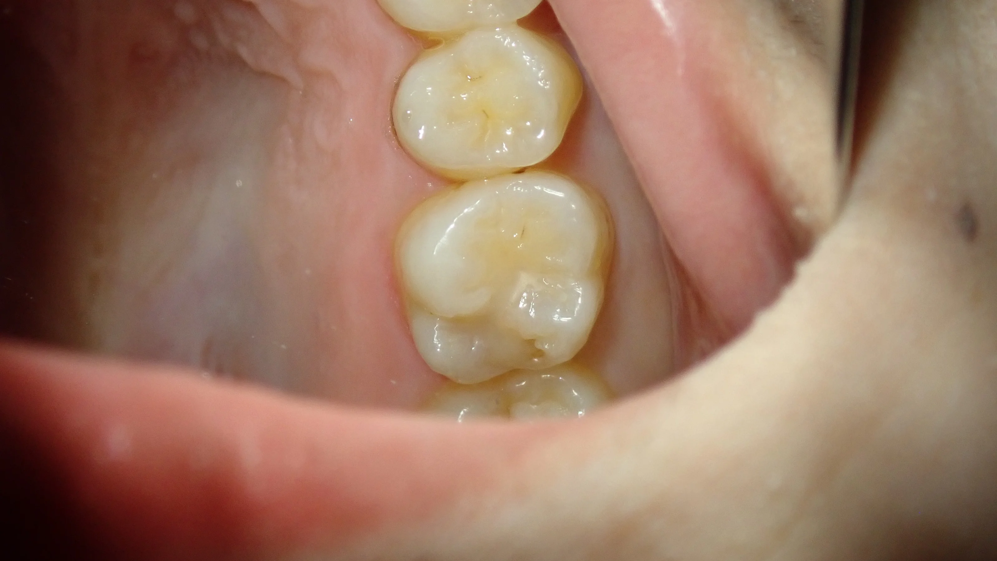 シールドレストレーション･･･？｜坂寄歯科医院（取手市藤代）