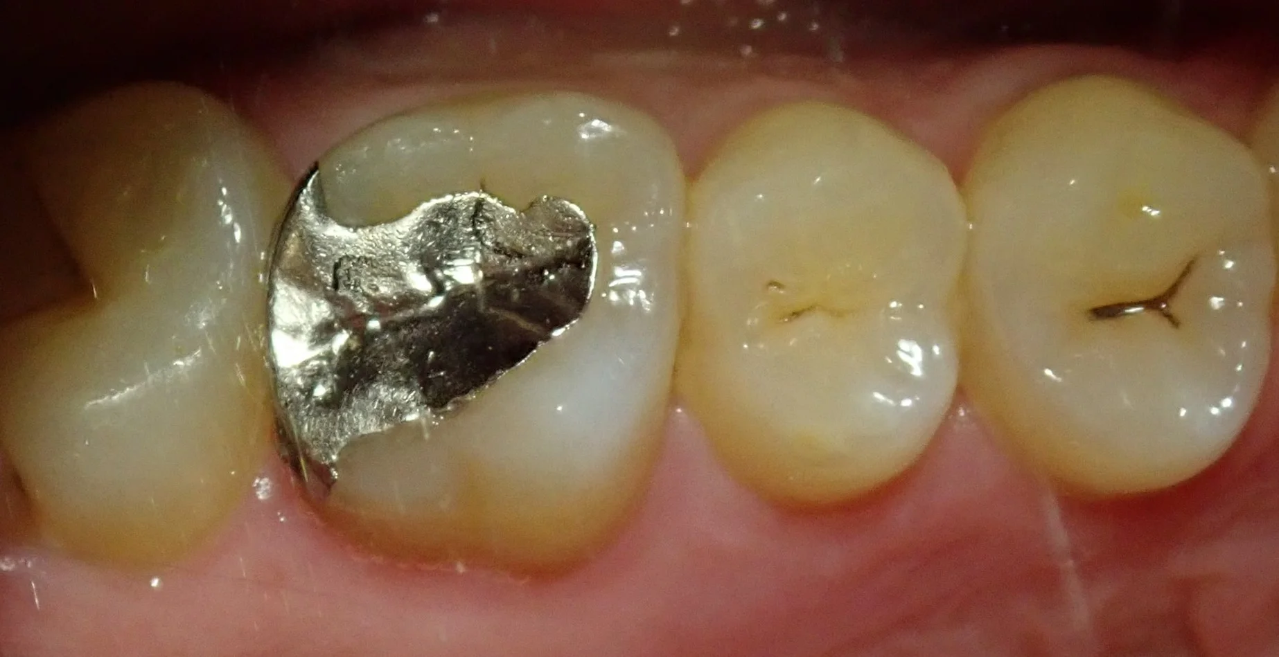 テフロンテープを用いたレジン治療｜坂寄歯科医院（取手市藤代）