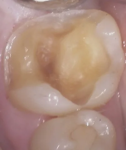 左下奥歯の白い詰め物｜坂寄歯科医院（取手市藤代） - 画像3