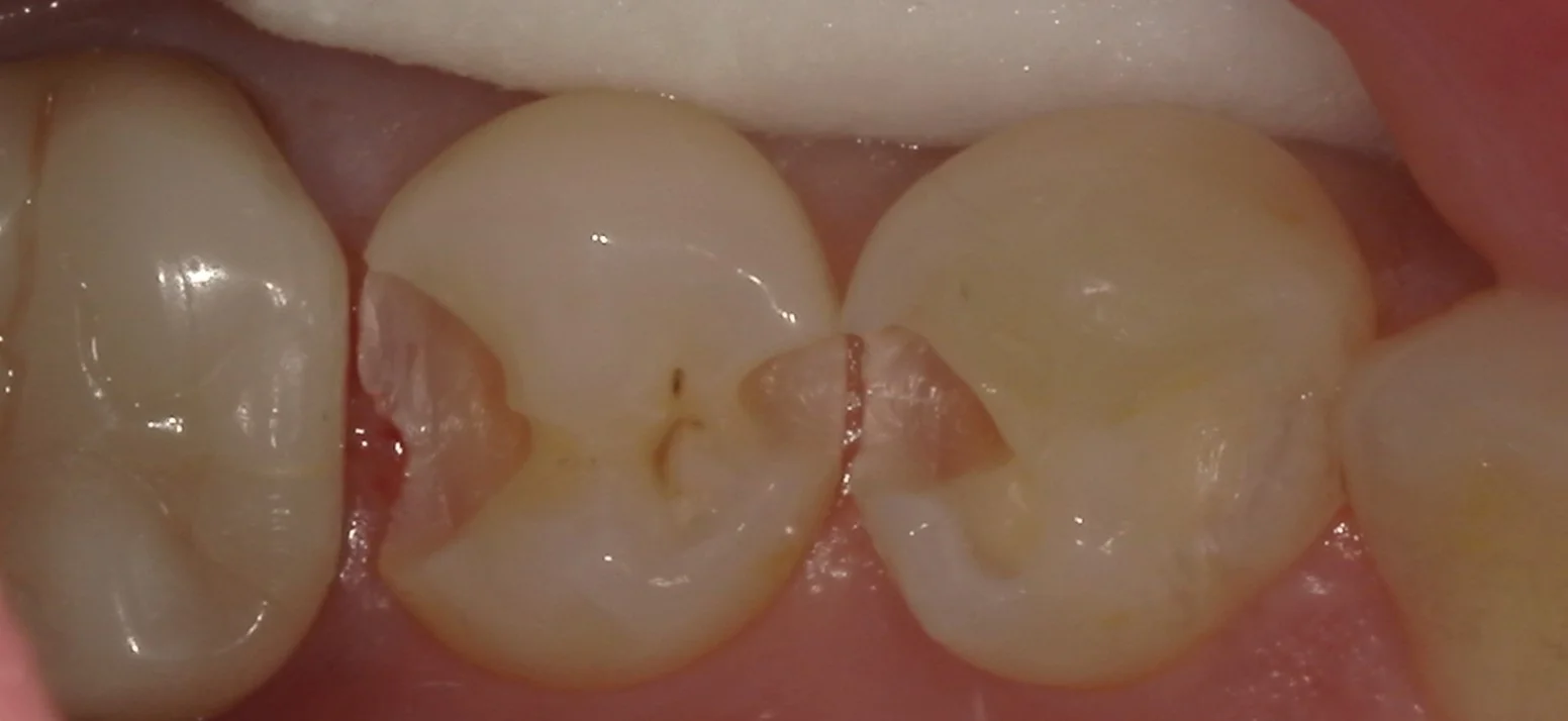 右下奥歯を纏めて治療。遠方からの通院。｜坂寄歯科医院（取手市藤代） - 画像3
