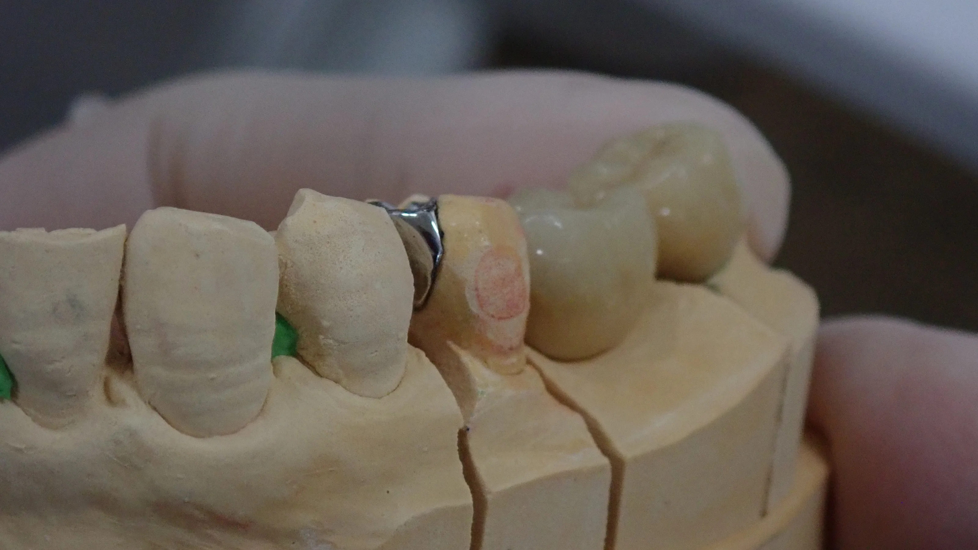 歯を可及的に温存したブリッジ|坂寄歯科医院(取手市藤代) - 画像6