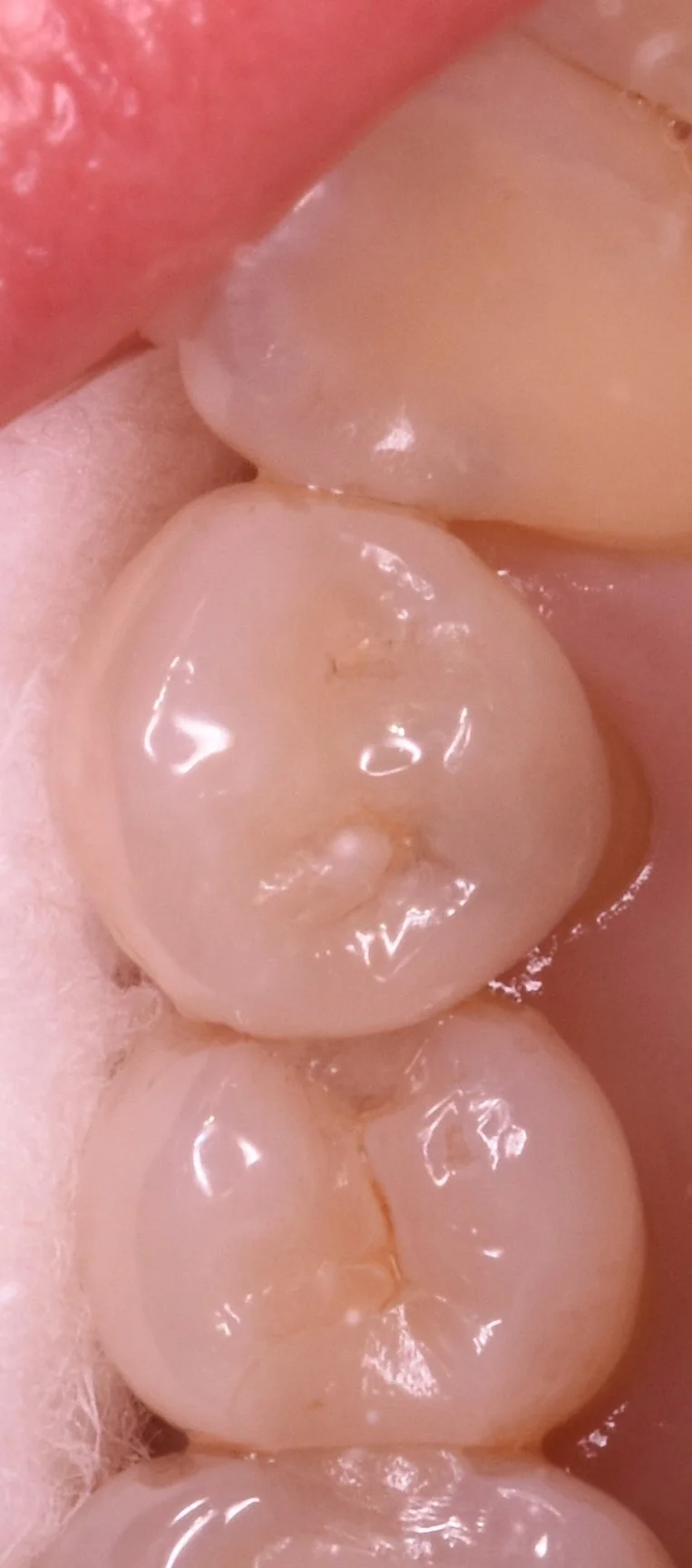 奥歯の歯並びが悪くなってしまっている所の治療｜坂寄歯科医院（取手市藤代）